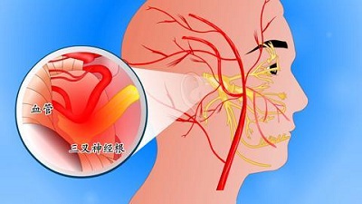 当耳朵后面神经痛的病因是什么 医学知识全接触 按疾病找科普知识 挂号通