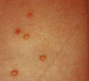 梅毒病毒症状图片图片